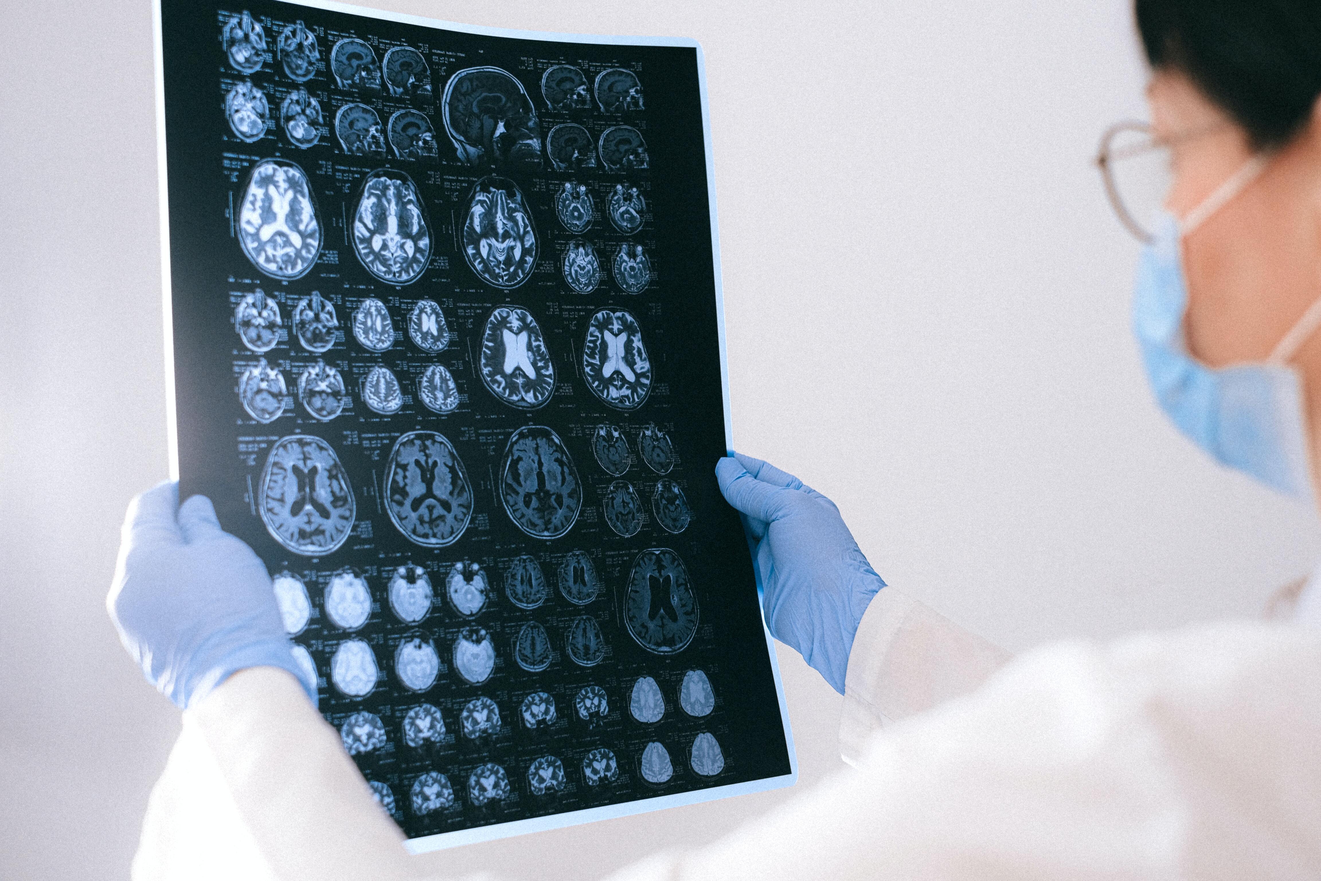 EMF Radiation and Your Brain: Are You at Risk of Brain Damage?